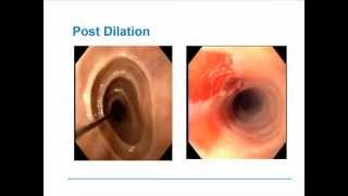 Eosinophilic Esophagitis [upl. by Kendre]