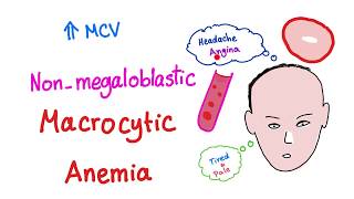 Nonmegaloblastic Macrocytic Anemia [upl. by Yekcor90]