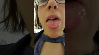 Got bALS  tongue fasciculations Oct 2019 [upl. by Carlin]