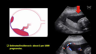 Ultrasound Imaging of the placenta Part 1 Anatomy and Variants [upl. by Geis]