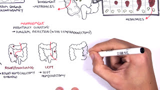 Colorectal Cancer  Overview [upl. by Layman]