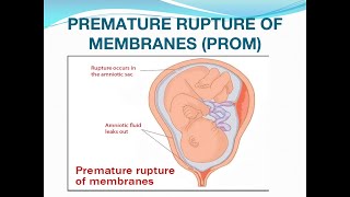 Premature rupture of membranes PROM [upl. by Elocn]