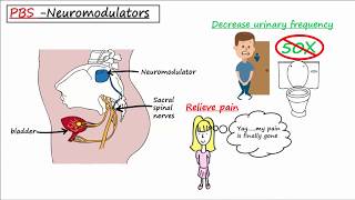 Painful Bladder Syndrome PBS  Interstitial Cystitis IC [upl. by Esinert]