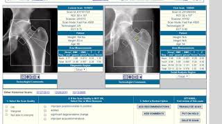 Reading a DXA bone mineral density BMD study in two minutes [upl. by Sihunn29]