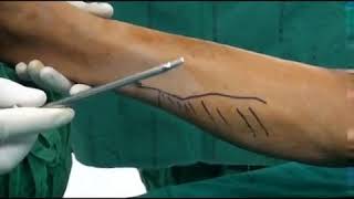 Endoscopic gastrocnemius recession Surgical Technique [upl. by Nowd]