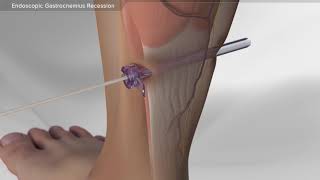 Endoscopic Gastrocnemius Recession [upl. by Kynthia]