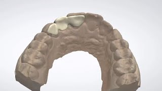 3Shape Dental System  Maryland Bridge Design [upl. by Llehsor]