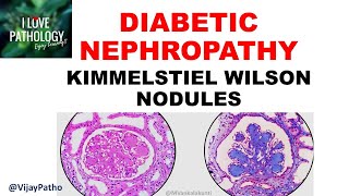 DIABETIC NEPHROPATHY Pathophysiology amp Morphology [upl. by Ahsieyk574]