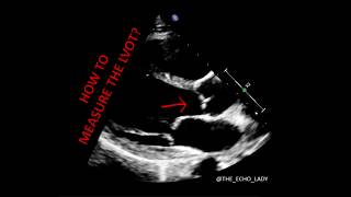 ECHOCARDIOGRAPHY How to measure the LVOT [upl. by Gass676]