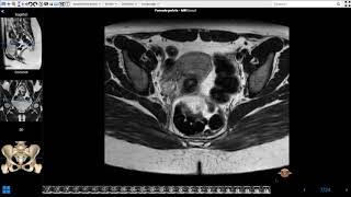 Female Pelvis MRI [upl. by Llennyl]