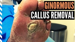 Ginormous Callus Removal [upl. by Uht]