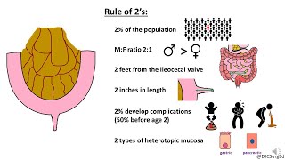 Meckel’s Diverticulum [upl. by Eiliab162]