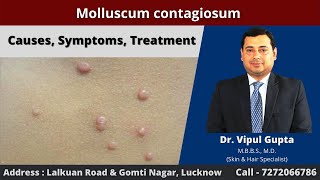 Molluscum contagiosum  Causes Symptoms Treatment [upl. by Jillayne]