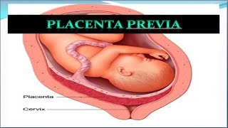 Placenta Previa Update [upl. by Yatnuahc285]