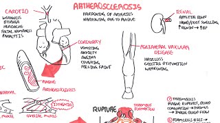 Atherosclerosis  Pathophysiology [upl. by Darice]