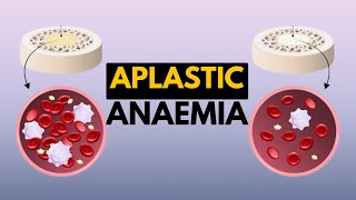 Aplastic Anaemia Causes Signs and Symptoms Diagnosis and Treatment [upl. by Caneghem]