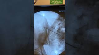 SacroIliac Joint Injection [upl. by Kaitlyn530]