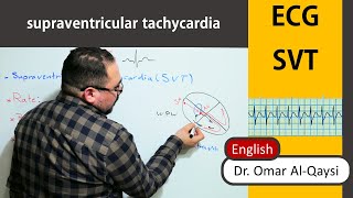 Non sustained Ventricular Tachycardia NSVT [upl. by Eitsym]