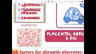 Placental abruption [upl. by Ferguson275]