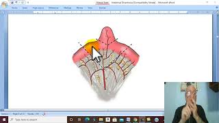 Intestinal Disorders in Arabic 7  Meckels Diverticulum   by Dr Wahdan [upl. by Elawalo825]