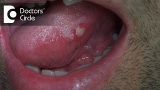 What are different circularlesions present on tongue  Dr Jayaprakash Ittigi [upl. by Dnomrej]