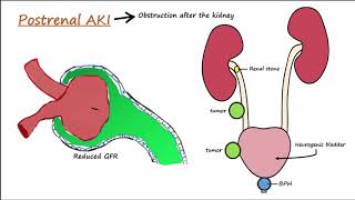 Acute Kidney Injury AKI  PrerenalIntrarenalPostrenal [upl. by Nuaj51]