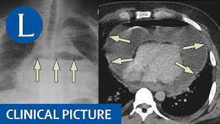 A purulent hydropneumopericardium causing cardiac tamponade [upl. by Arodoeht63]