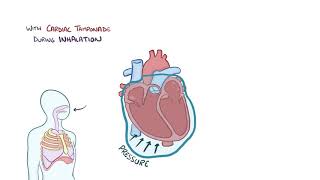 Cardiac tamponade causes symptoms diagnosis treatment pathology [upl. by Jezreel]