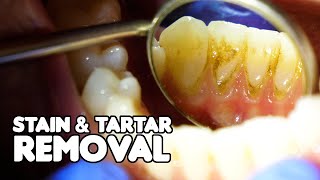 Dental Cleaning EXPLAINED  Stain amp Tartar Removal [upl. by Geirk]