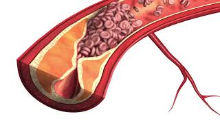 Atherosclerosis  Plaque Animation Model [upl. by Ignatius]