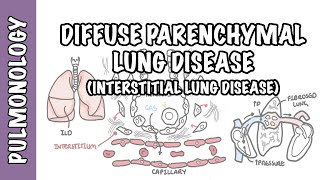 Interstitial Lung Disease ILD  Classification pathophysiology signs and symptoms [upl. by Nraa]