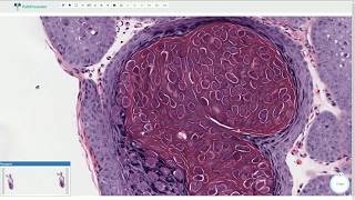 Molluscum Contagiosum  Histopathology [upl. by Akahc]