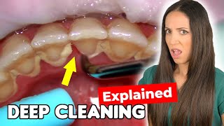 Dental Hygienist Explains Deep Cleaning Procedure [upl. by Navarro9]