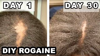 How I fixed my BALD SPOT  DIY Rogaine on 4C Natural Hair [upl. by Stoller]