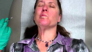 Botox Treatment for Bells Palsy [upl. by Icken]