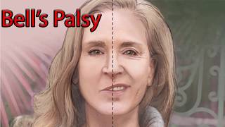 Bells Palsy  Facial Nerve palsy [upl. by Llyrat]