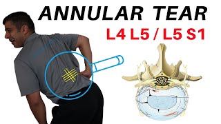 Annular Tear L4L5 L5S1 Disc Bulges [upl. by Anaed863]