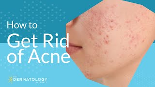 Acne Treatment  Explained by Dermatologist [upl. by Guria]