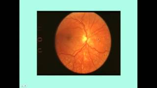 Hypertensive Retinopathy  CRASH Medical Review Series [upl. by Holna697]