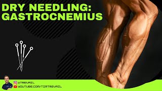 Dry Needling Gastrocnemius [upl. by Zacharia]