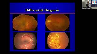 Lecture Retinal Vein Occlusion Dr David Miller [upl. by Sgninnej641]