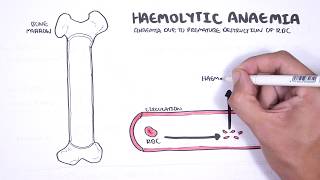 Haemolytic Anaemia  classification intravascular extravascular pathophysiology investigations [upl. by Aikkin]