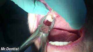 Extraction Of Molar Tooth [upl. by Lila]